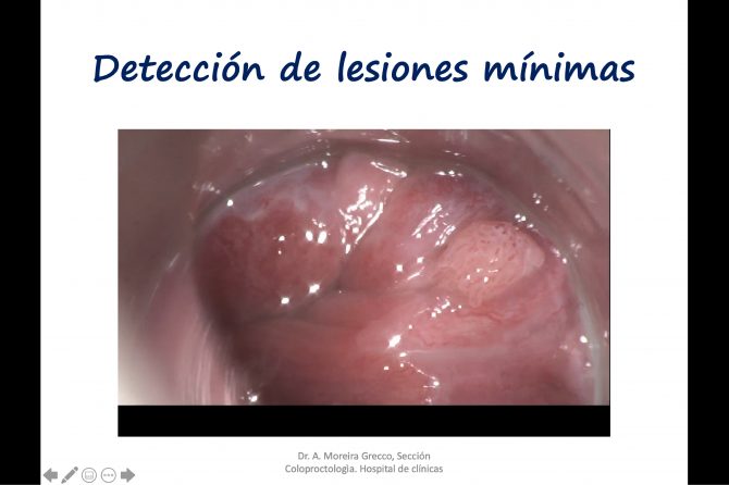 lesion minima endoanal