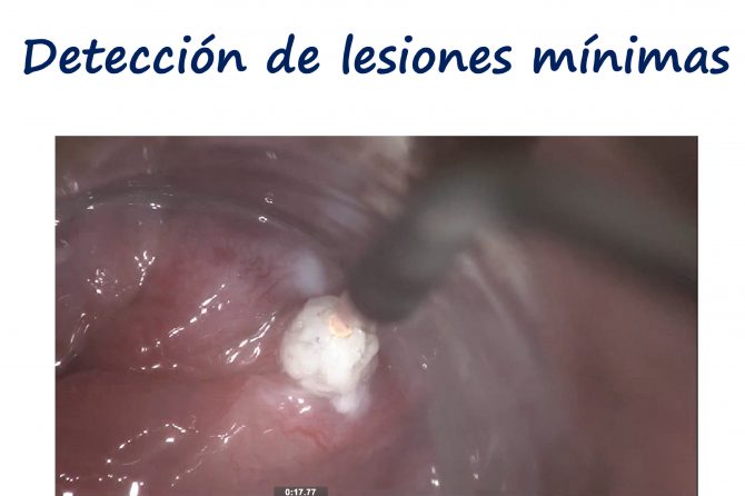 Displasia anal por HPV